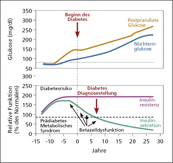 Typ 2-Diabetes