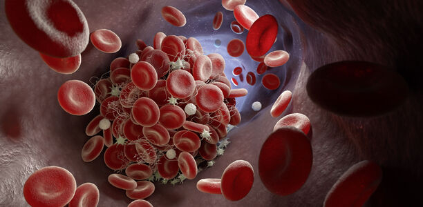 Bild zu Fortbildung - Korrelation: Covid-19, Blutgerinnung und Thrombose